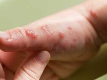 Descartan autoridades sanitarias en Cartagena casos activos de viruela simica