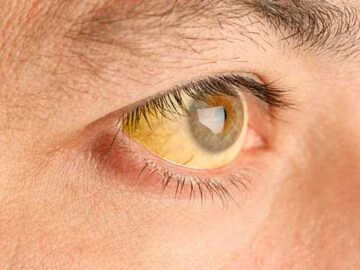 Se activa un plan especial de vigilancia por casos de