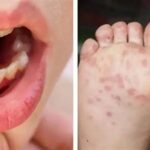 Recomendaciones de la autoridad sanitaria de Cartagena debido a alerta.webp