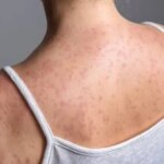 Cartagena en alerta por confirmacion de casos de sarampion en