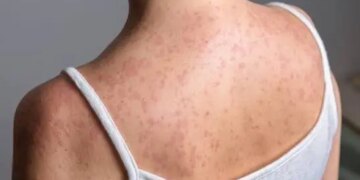 Cartagena en alerta por confirmacion de casos de sarampion en