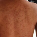 Nuevo caso de Sarampion detectado en Cartagena